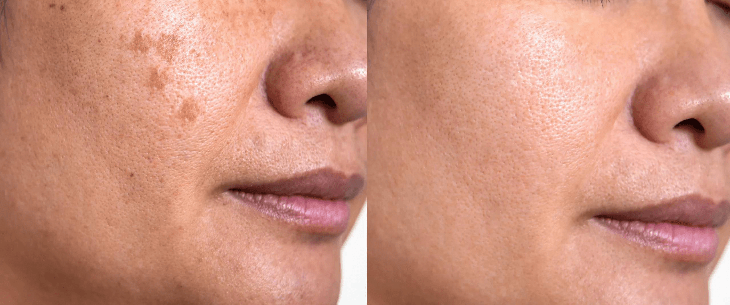Treatment Melasma Efektif dan Aman: Lebih dari Sekadar Memutihkan